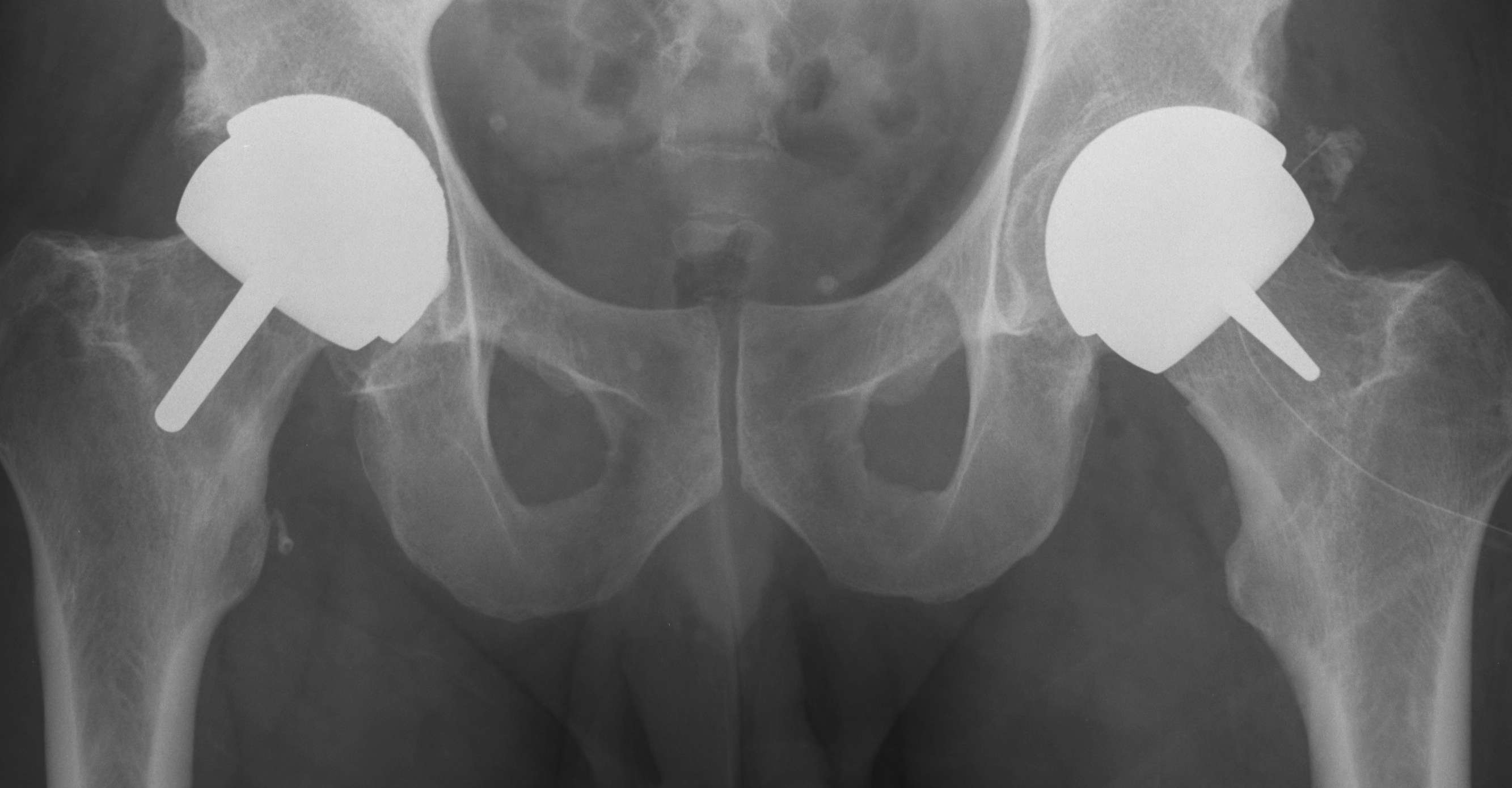 BHR Open v Closed Acetabular Component